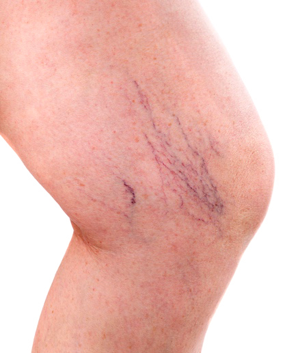 Varicose Veins - Causes, Symptoms, Removal & Treatments - Auckland
